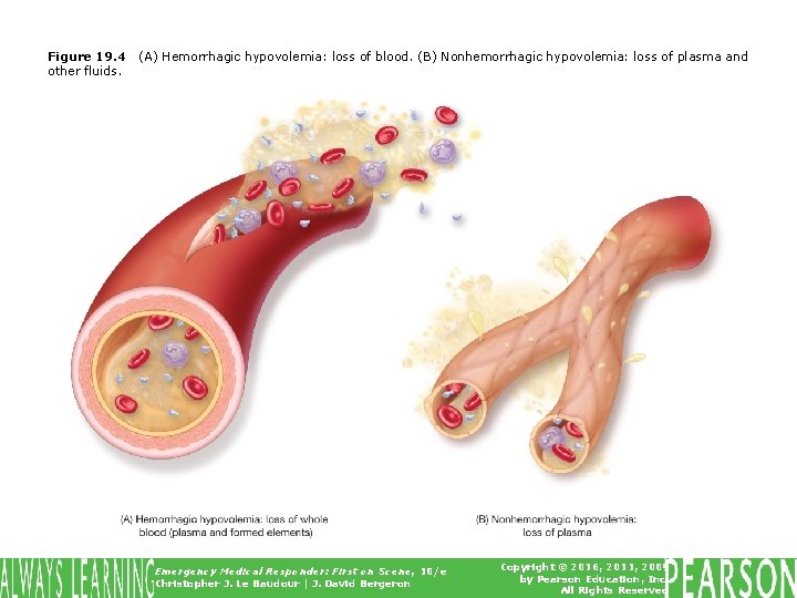 Figure 19. 4 other fluids. (A) Hemorrhagic hypovolemia: loss of blood. (B) Nonhemorrhagic hypovolemia: