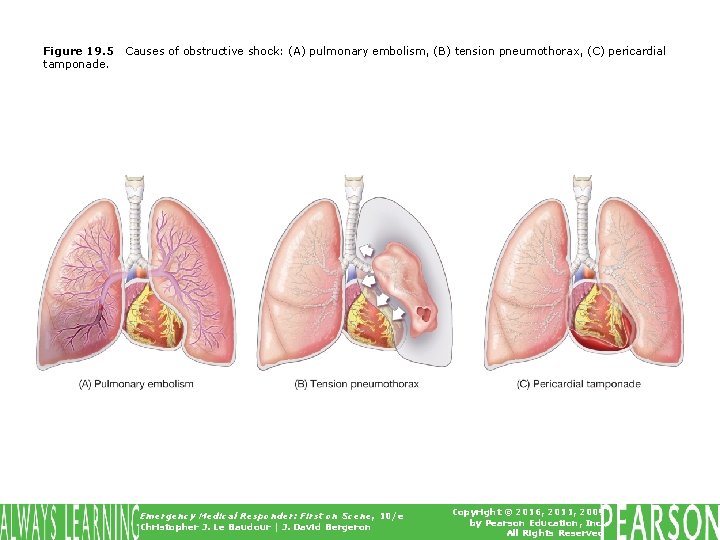 Figure 19. 5 tamponade. Causes of obstructive shock: (A) pulmonary embolism, (B) tension pneumothorax,