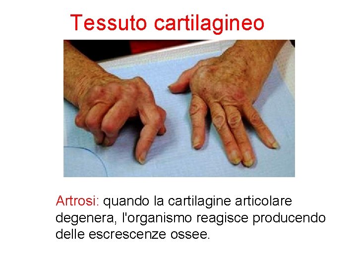 Tessuto cartilagineo Artrosi: quando la cartilagine articolare degenera, l'organismo reagisce producendo delle escrescenze