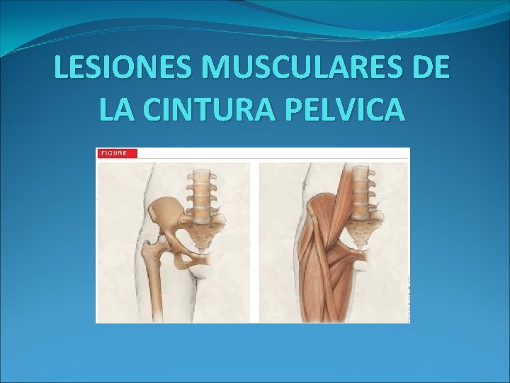 LESIONES MUSCULARES DE LA CINTURA PELVICA 