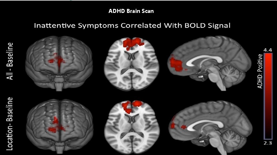 ADHD Overview Diagnosis & Treatment Concord Comprehensive Neuropsychology Services ADHD Brain Scan Additional Required