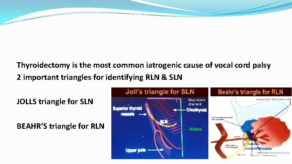 Thyroidectomy is the most common iatrogenic cause of vocal cord palsy 2 important triangles