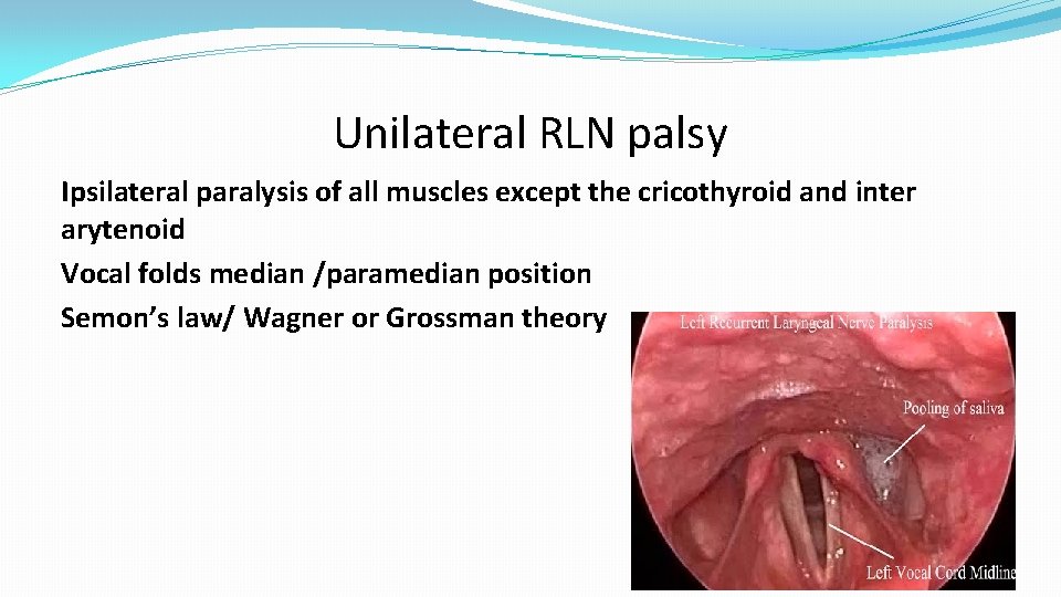 Unilateral RLN palsy Ipsilateral paralysis of all muscles except the cricothyroid and inter arytenoid