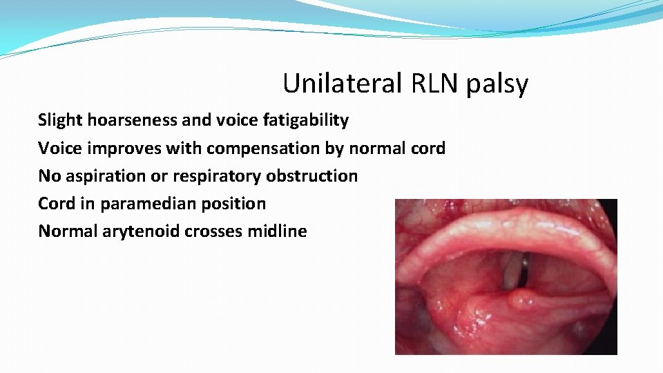Unilateral RLN palsy Slight hoarseness and voice fatigability Voice improves with compensation by normal