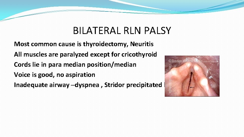 BILATERAL RLN PALSY Most common cause is thyroidectomy, Neuritis All muscles are paralyzed except