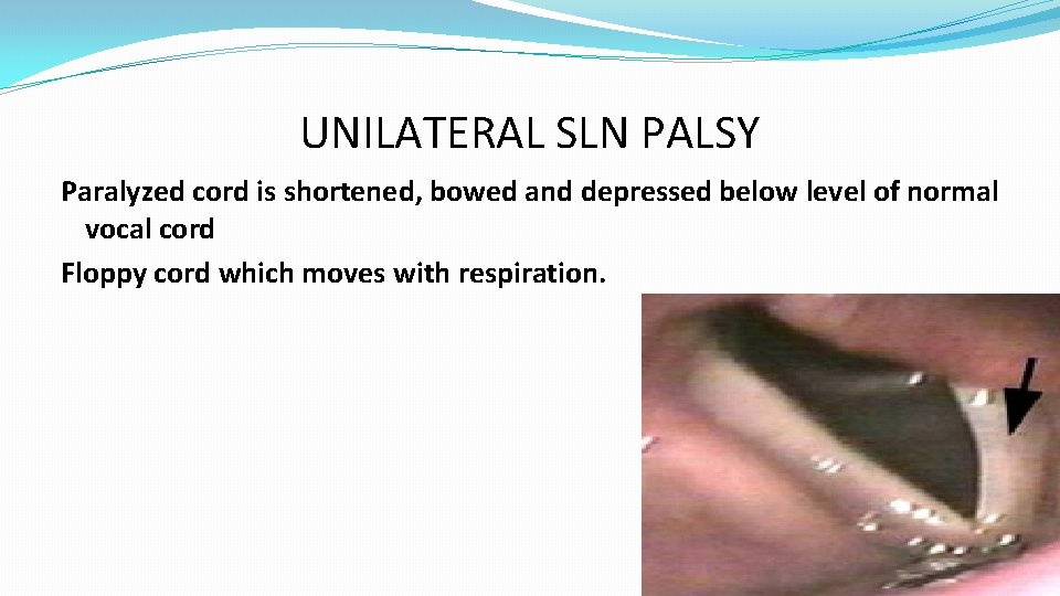 UNILATERAL SLN PALSY Paralyzed cord is shortened, bowed and depressed below level of normal