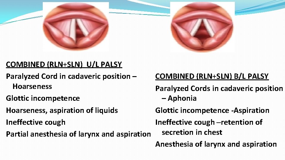 COMBINED (RLN+SLN) U/L PALSY Paralyzed Cord in cadaveric position – Hoarseness Glottic incompetence Hoarseness,