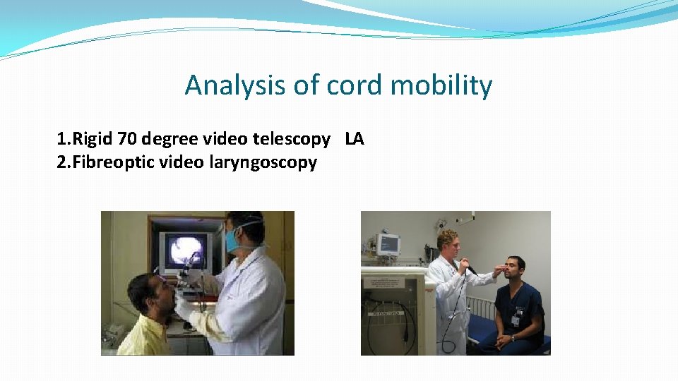 Analysis of cord mobility 1. Rigid 70 degree video telescopy LA 2. Fibreoptic video