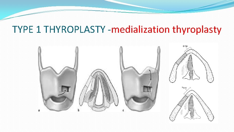 TYPE 1 THYROPLASTY -medialization thyroplasty 
