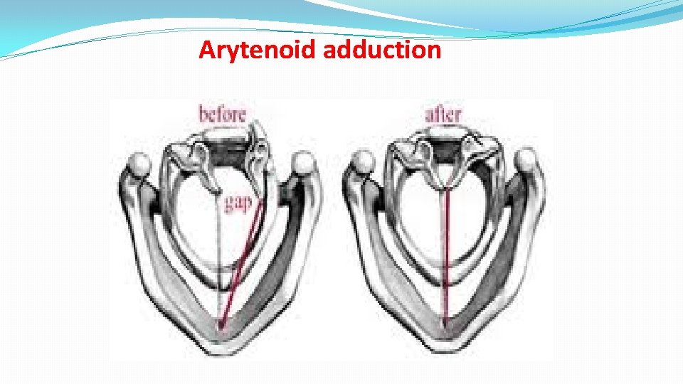 Arytenoid adduction 