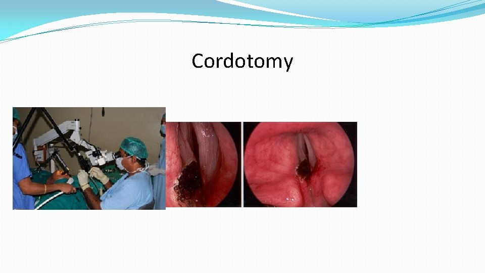 Cordotomy 