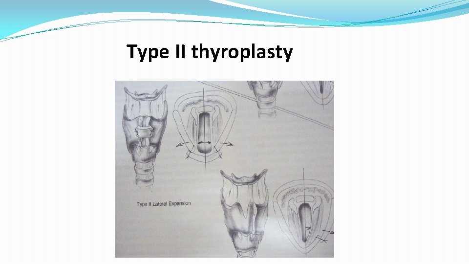 Type II thyroplasty 