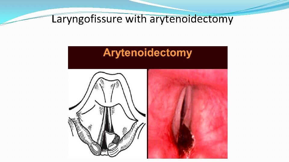 Laryngofissure with arytenoidectomy 