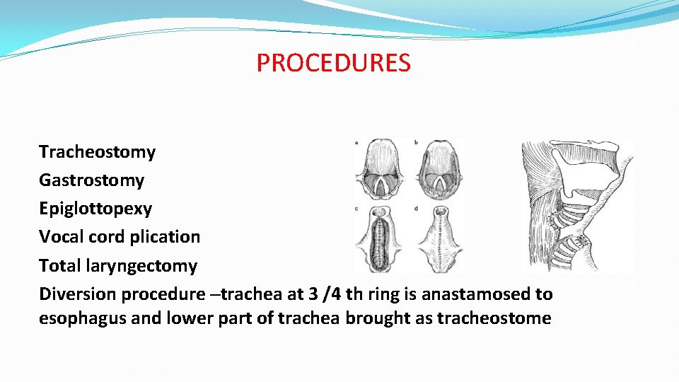 PROCEDURES Tracheostomy Gastrostomy Epiglottopexy Vocal cord plication Total laryngectomy Diversion procedure –trachea at 3