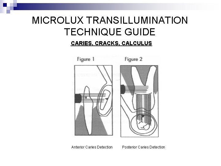 MICROLUX TRANSILLUMINATION TECHNIQUE GUIDE CARIES, CRACKS, CALCULUS Anterior Caries Detection Posterior Caries Detection 