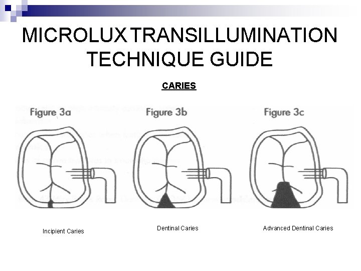 MICROLUX TRANSILLUMINATION TECHNIQUE GUIDE CARIES Incipient Caries Dentinal Caries Advanced Dentinal Caries 