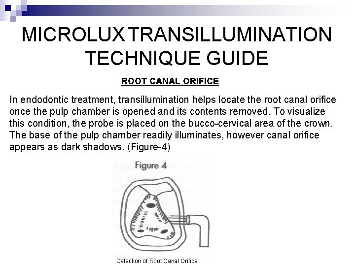 MICROLUX TRANSILLUMINATION TECHNIQUE GUIDE ROOT CANAL ORIFICE In endodontic treatment, transillumination helps locate the