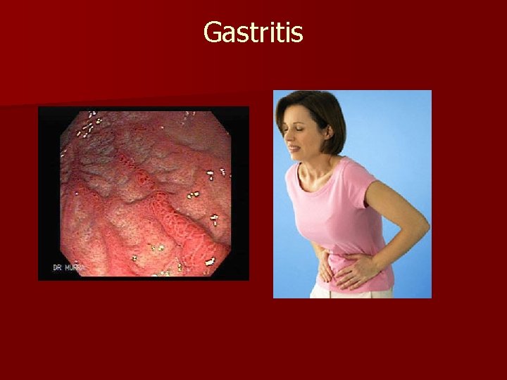 Gastritis 
