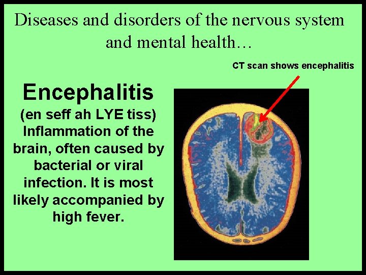 Diseases and disorders of the nervous system and mental health… CT scan shows encephalitis