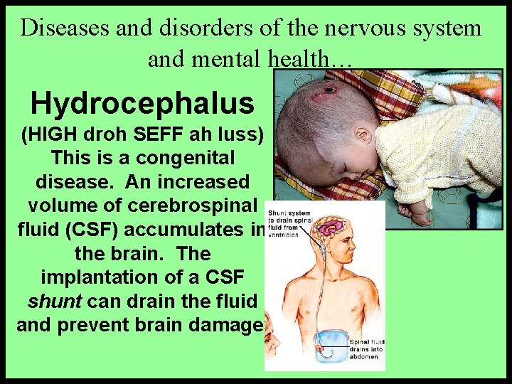 Diseases and disorders of the nervous system and mental health… Hydrocephalus (HIGH droh SEFF