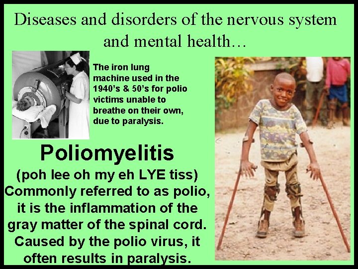 Diseases and disorders of the nervous system and mental health… The iron lung machine