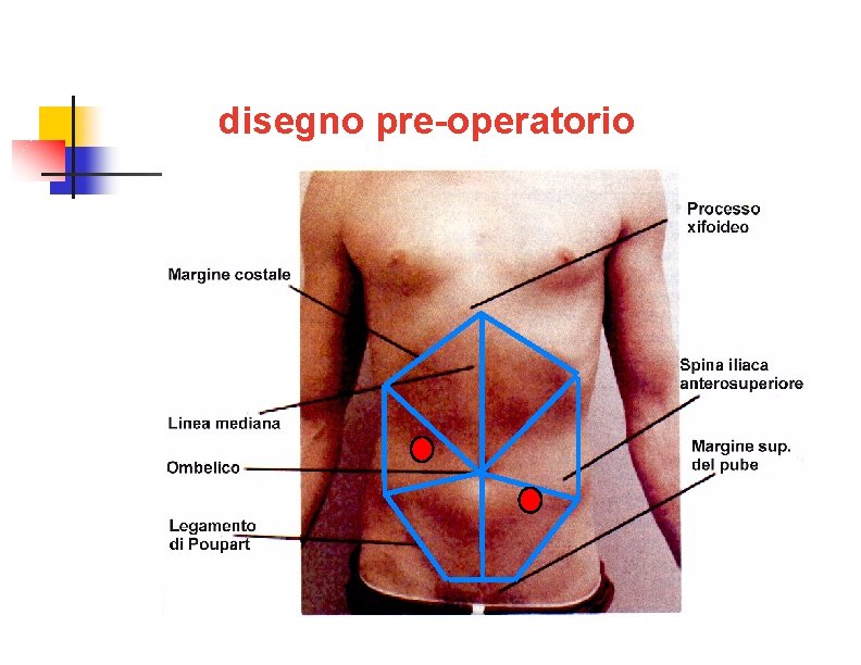 disegno pre-operatorio 