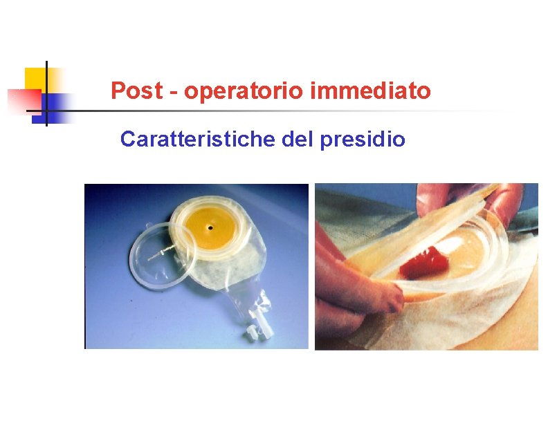 Post - operatorio immediato Caratteristiche del presidio 1 pezzo con oblò 2 pezzi (soffietto)