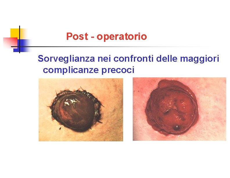 Post - operatorio Sorveglianza nei confronti delle maggiori complicanze precoci Necrosi Emorragia 