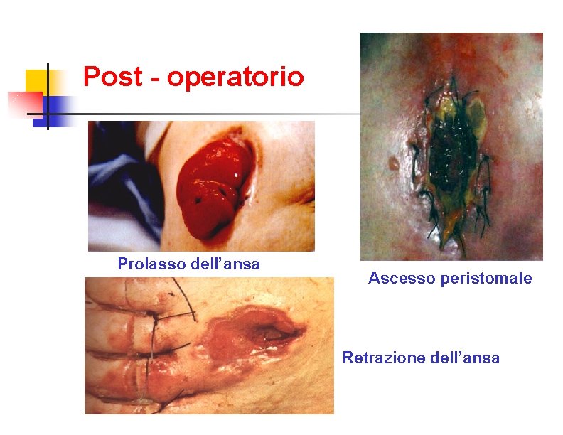 Post - operatorio Prolasso dell’ansa Ascesso peristomale Retrazione dell’ansa 