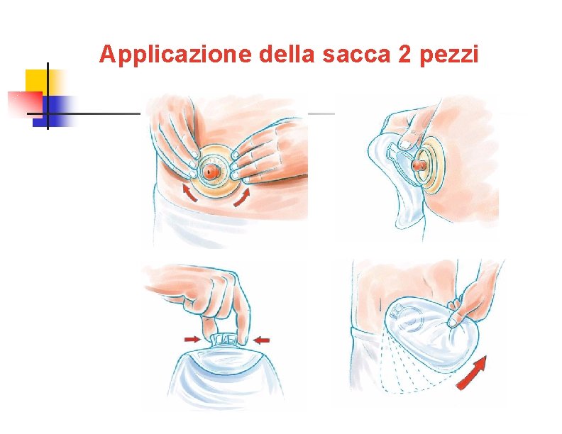 Applicazione della sacca 2 pezzi 