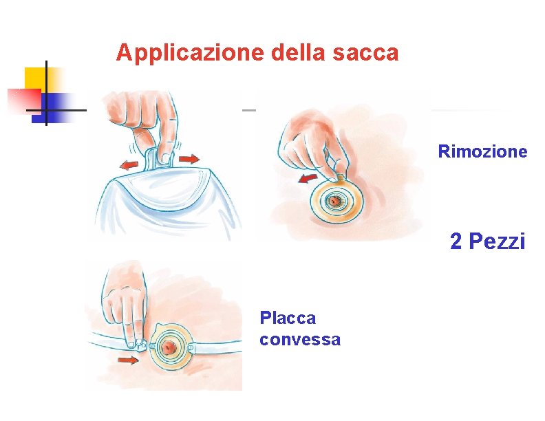 Applicazione della sacca Rimozione 2 Pezzi Placca convessa 