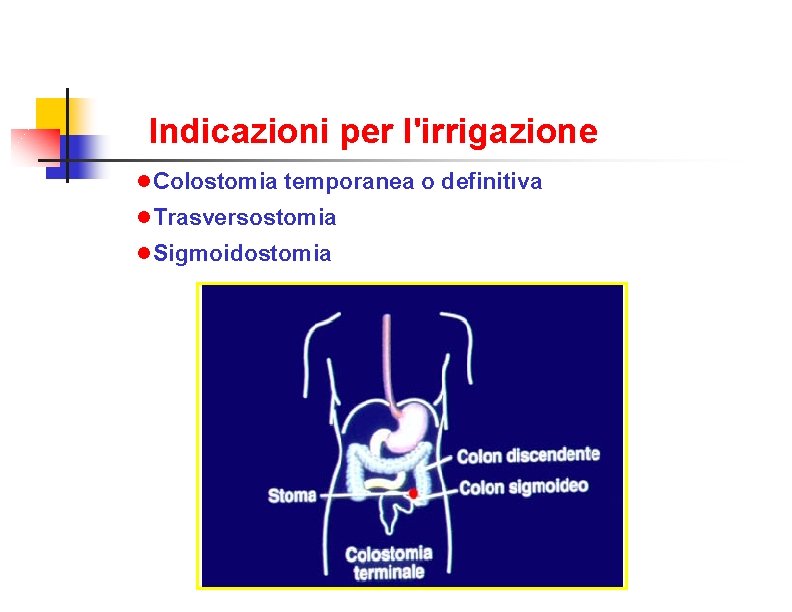 Indicazioni per l'irrigazione Colostomia temporanea o definitiva Trasversostomia Sigmoidostomia 