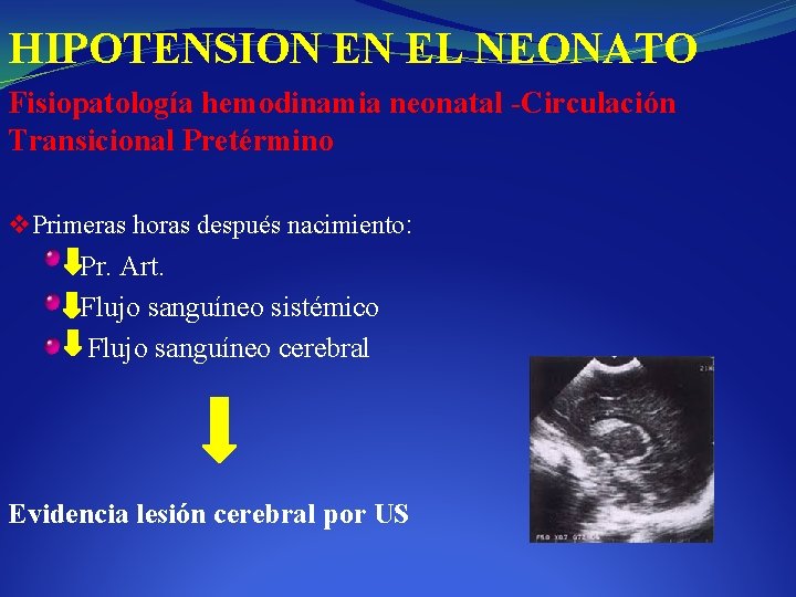 HIPOTENSION EN EL NEONATO Fisiopatología hemodinamia neonatal -Circulación Transicional Pretérmino v Primeras horas después