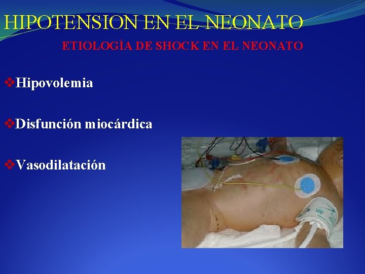 HIPOTENSION EN EL NEONATO ETIOLOGÍA DE SHOCK EN EL NEONATO v. Hipovolemia v. Disfunción