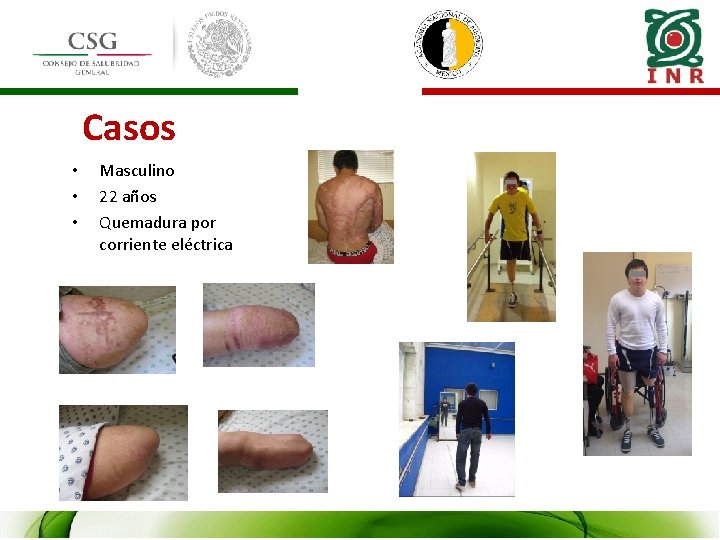 Casos • • • Masculino 22 años Quemadura por corriente eléctrica 