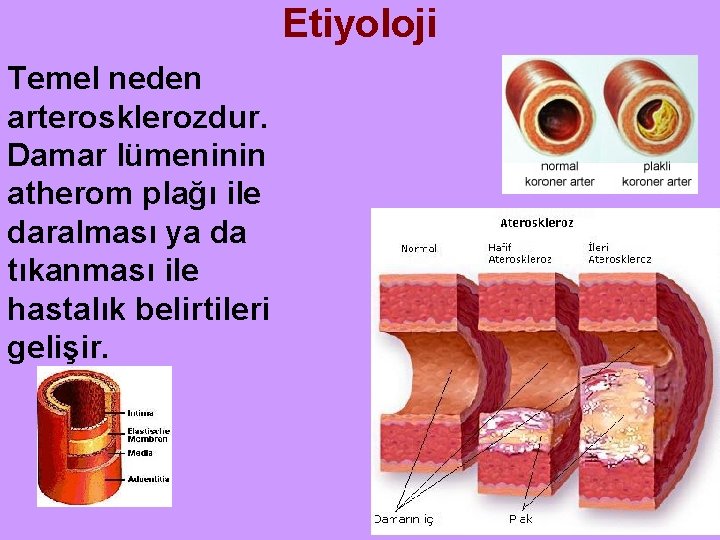 Etiyoloji Temel neden arterosklerozdur. Damar lümeninin atherom plağı ile daralması ya da tıkanması ile