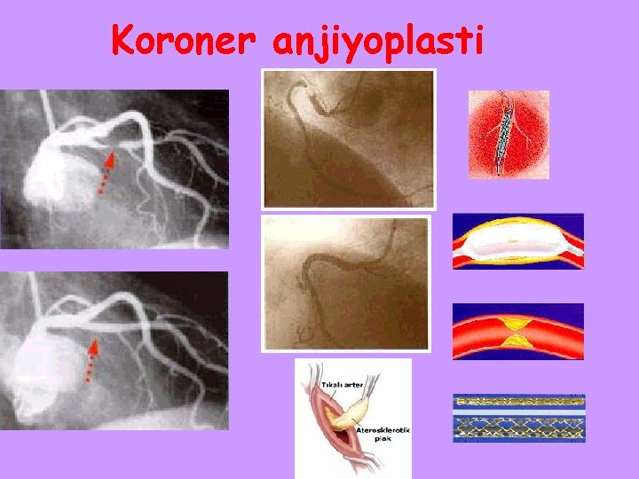 Koroner anjiyoplasti 