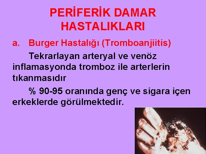 PERİFERİK DAMAR HASTALIKLARI a. Burger Hastalığı (Tromboanjiitis) Tekrarlayan arteryal ve venöz inflamasyonda tromboz ile