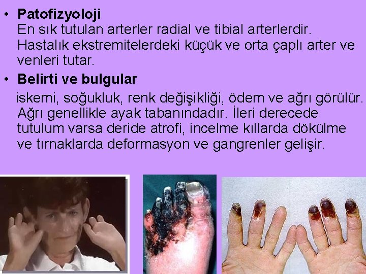  • Patofizyoloji En sık tutulan arterler radial ve tibial arterlerdir. Hastalık ekstremitelerdeki küçük