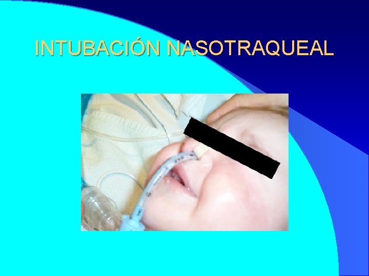 INTUBACIÓN NASOTRAQUEAL 