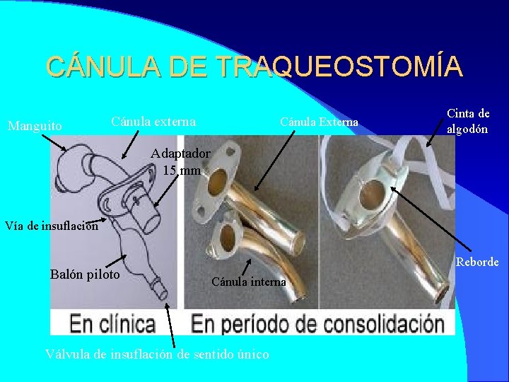 CÁNULA DE TRAQUEOSTOMÍA Manguito Cánula externa Cánula Externa Cinta de algodón Adaptador 15 mm