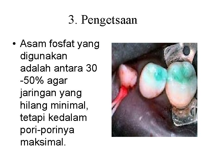 3. Pengetsaan • Asam fosfat yang digunakan adalah antara 30 -50% agar jaringan yang 3. Pengetsaan • Asam fosfat yang digunakan adalah antara 30 -50% agar jaringan yang