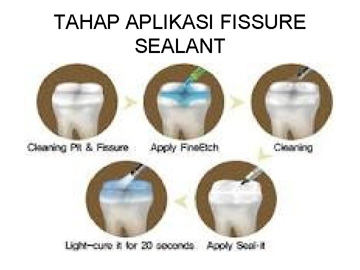 TAHAP APLIKASI FISSURE SEALANT TAHAP APLIKASI FISSURE SEALANT