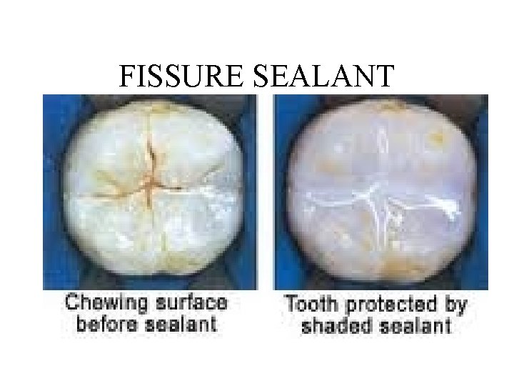 FISSURE SEALANT FISSURE SEALANT