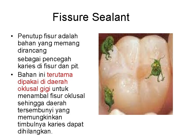 Fissure Sealant • Penutup fisur adalah bahan yang memang dirancang sebagai pencegah karies di Fissure Sealant • Penutup fisur adalah bahan yang memang dirancang sebagai pencegah karies di