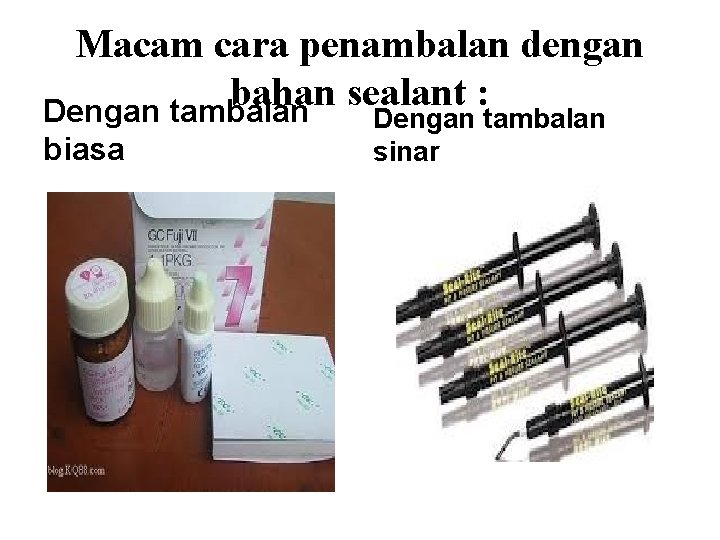 Macam cara penambalan dengan bahan sealant : Dengan tambalan biasa Dengan tambalan sinar Macam cara penambalan dengan bahan sealant : Dengan tambalan biasa Dengan tambalan sinar