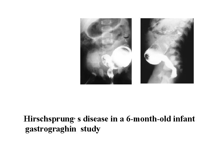 Hirschsprung, s disease in a 6 -month-old infant gastrograghin study Hirschsprung, s disease in a 6 -month-old infant gastrograghin study