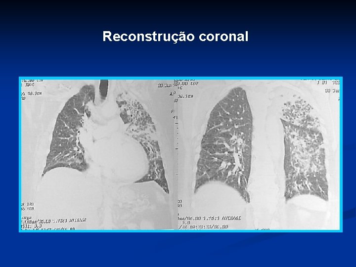 Reconstrução coronal 