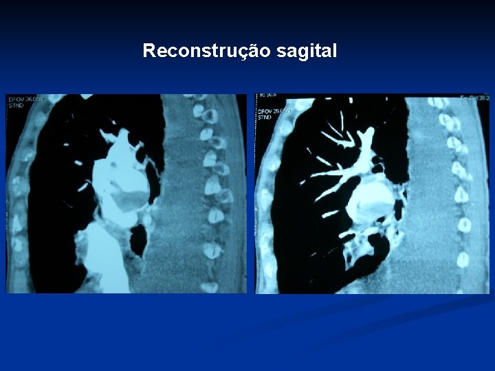 Reconstrução sagital 