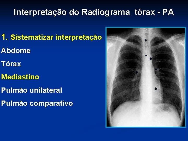 Interpretação do Radiograma tórax - PA 1. Sistematizar interpretação Abdome Tórax Mediastino Pulmão unilateral